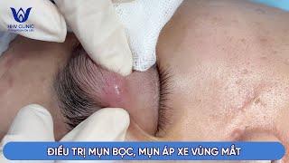 ĐIỀU TRỊ MỤN BỌC VÙNG MẮT TẠI PHÒNG KHÁM DA LIỄU HHV CLINIC