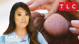 Holy Cyst! Biggest Cyst Removals | Dr. Pimple Popper | TLC