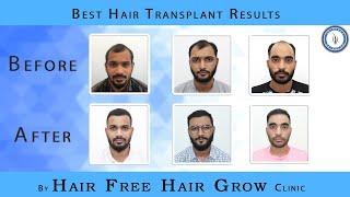 Hair Transplant Results  || hair transplant In Surat || Hairfree & Hairgrow Clinic India