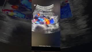 Pancreas ultrasound chronic calcified panceatitis