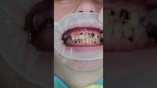 Transform Your Smile in Prague #shorts #dentist #dental #veneers #short