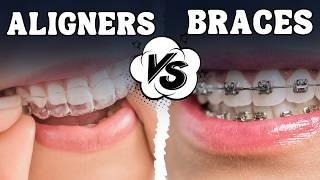 Clear Aligners vs Braces | Invisible Aligners | OrthoSquare Dental Clinic