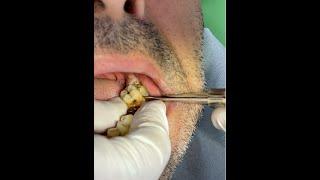 Yarı gömülü yirmilik diş ve azı dişin 1 dakikada çekimi//Wisdom teeth removal in 1 minutes.Asmr