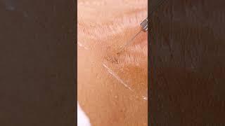 Up close view of how laser stretch mark removal works!  #shorts