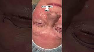 Upper Blepharoplasty + Under Eye Resurfacing Laser