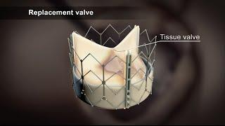 TAVI (Transcatheter Aortic Valve Implantation)