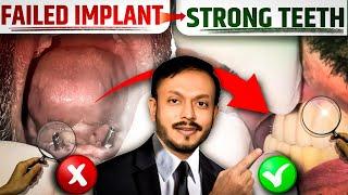 Conventional Implant fail हो चुका था  ! बची हुई जगह में immidiate implant place कर के fix dant hua