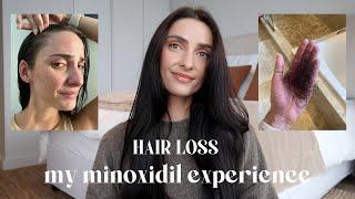 MY MINOXIDIL EXPERIENCE | androgenetic alopecia, hair loss, my hair loss journey (MY AGA EXPERIENCE)