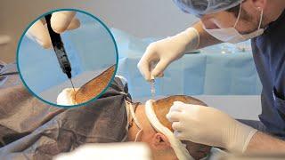 Is a Hair Transplant Painful? All Your Questions Answered | Elithair