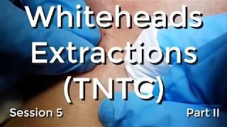 Whiteheads Extraction (TNTC) - Session 5 Part II