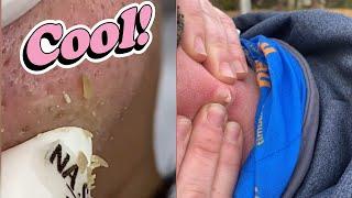 Explosive Pimple Pooping!  Ultimate Pimple Popping Compilation