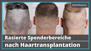 Nach Haartransplantation: Wie kurz kann man die Haare noch tragen? [10 rasierte Entnahmebereiche]