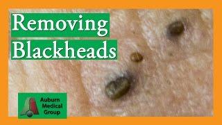 Several Blackheads | Auburn Medical Group