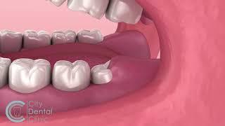 Problem with widsdom teeth