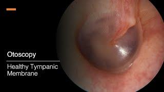 Tympanic Membrane Otosopy