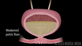Stress Urinary Incontinence in Women, Animation
