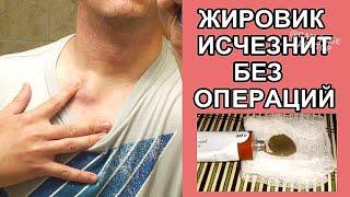 ХИРУРГ НЕ ПОВЕРИЛ,ЧТО Я ИЗБАВИЛАСЬ ОТ ЖИРОВИКА ПРОСТОЙ МАЗЬЮ.GET RID OF THE WEN WITH OINTMENT