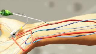 Radial artery puncture using the 'Insyte and Angiocath' technique