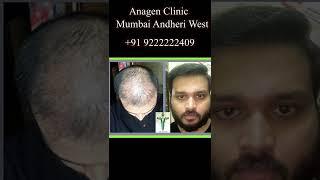 Hair Transplant // Mumbai Andheri West// #mumbaihairtransplant #hairtransplantmumbai