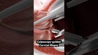 Taking a sample from the cervix (3D Animation)