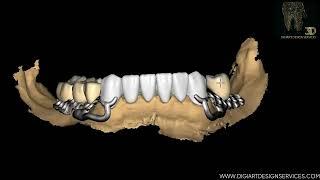 High-Quality Removable Partial Dentures (RPD) with Teeth | DigiArt Design Services