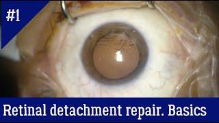 The general principles of vitrectomy for retinal detachment repair