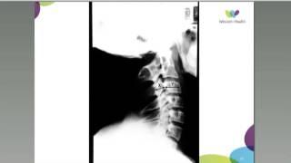 Cervical Spondylosis, Radiculopathy and Myelopathy by Dr James Churchill