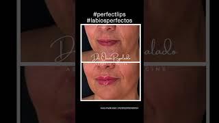 Espectacular resultado de relleno de ácido hialurónico para mejorar los labios¡Paciente feliz!