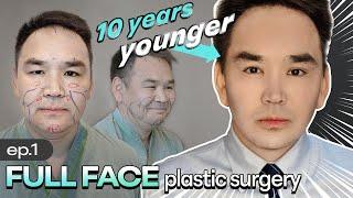 Mongolian Actor got face lift in KOREA│Male plastic surgery (PART 1)