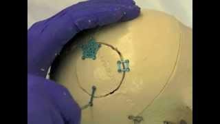 Cranial Flap Fixation