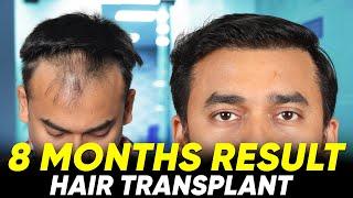 Hair Transplant in Hyderabad | Best Results & Cost of Hair Transplant in Hyderabad