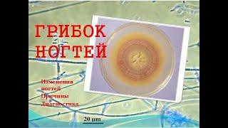 Грибок ногтей. Изменение ногтей. Причины, диагностика. Грибок ногтей лечение. (часть 1).