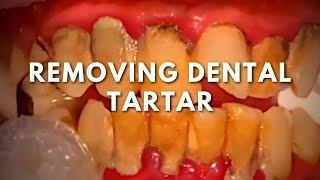 Dental tartar removal | Teeth cleaning procedure!