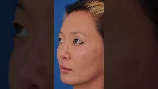 Revision Rhinoplasty | Nose Job Before & After