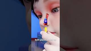 Lego Stuck In Nose For 26 Years  Surgeon Reacts