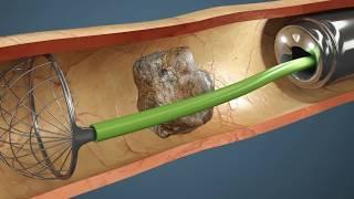 Como é feita a Cirurgia de Pedra nos Rins? Vídeo da cirurgia em 3D