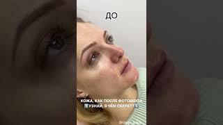 Фотоомоложение на аппарате М22: гладкая ровная кожа, как после фотошопа!