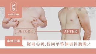 男性女乳症手術After Q&A＿台中格嘉整形外科洪章桂醫師案例