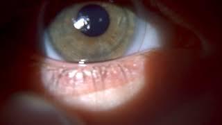 Посадка торических мягких контактных линз OKVision® Prima Bio Toric (правый глаз)