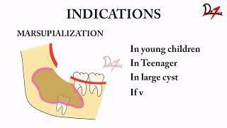 HOW IS MARSUPIALIZATION DONE?