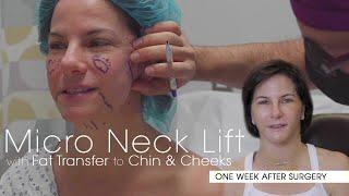 Micro Neck Lift Experience: One Week After Surgery
