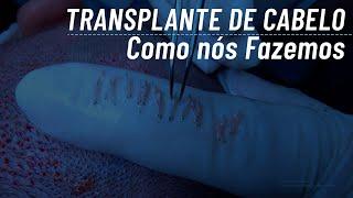 O que é transplante capilar - Como é feito o transplante capilar