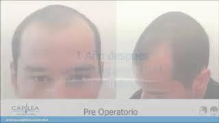 Técnica FUE | CAPILEA