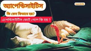 অ্যাপেন্ডিসাইটিস কি কেন কিভাবে হয়?।। What causes Appendicitis।। অ্যাপেন্ডিক্স ফেটে গেলে কি হয়?