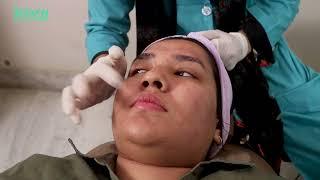 Microneedling with PRP Treatment | Adorn Laser Care