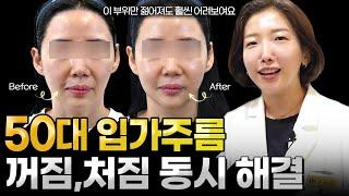 입가주름, 입가처짐, 마리오넷주름 없애는 법. 진짜 좋아집니다. 50대이상 필수시청!