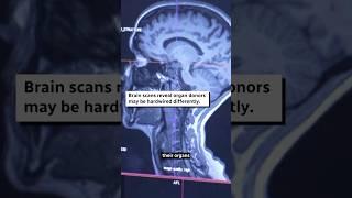 Brain scans reveal organ donors may be hardwired differently  #shorts