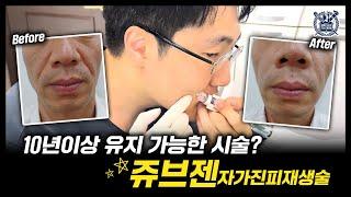 10년이상 유지 가능한 시술? 쥬브젠 자가진피재생술