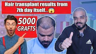 Hair Growth in Just 7 days , Fastest Hair transplant results | Best hair transplant in Odisha