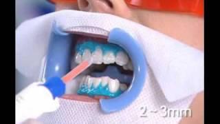 Teeth whitening Beirut Lebanon - Hollywood Smile Ferrari Dental Clinic